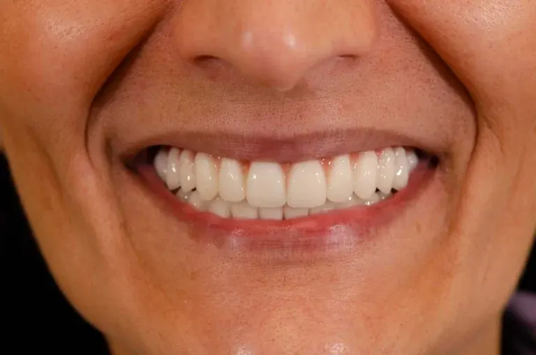 Zubni implanti – Mr Smile Implant — detalj tretmana i rezultata