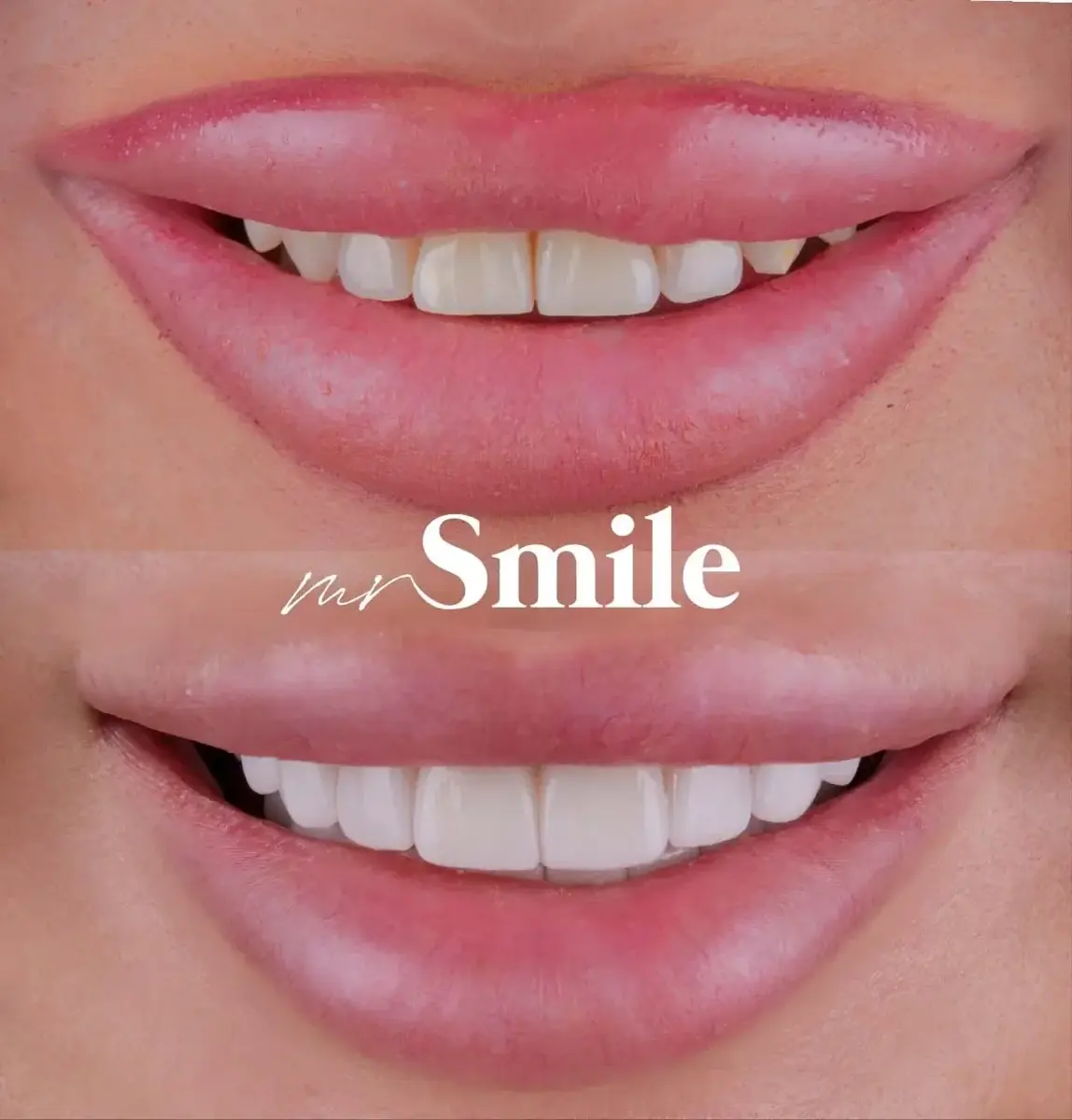 Mr Smile Preview – dizajn budućeg osmeha — rad i individualna estetika