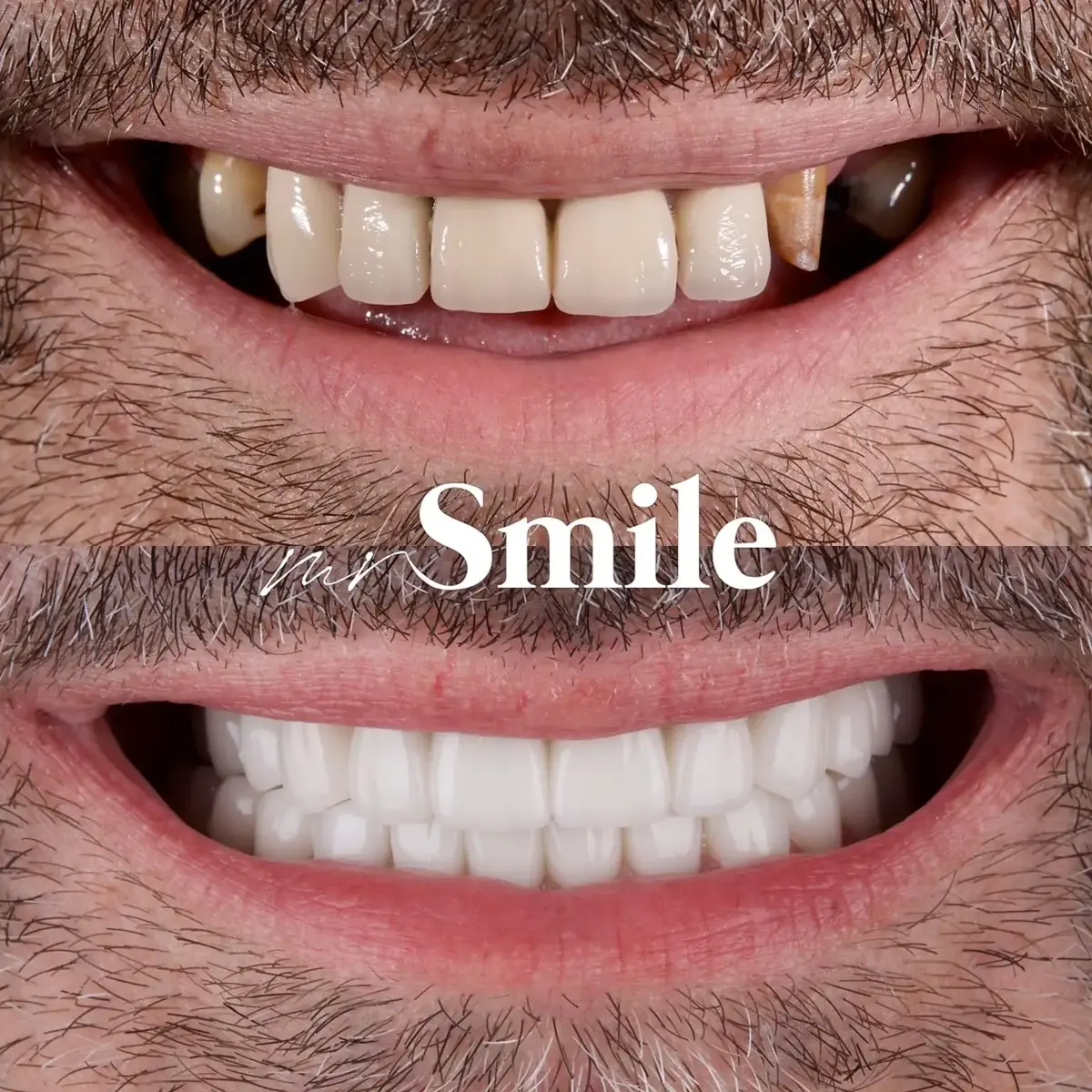 Mr Smile Makeover – transformacija osmeha — detalj tretmana i rezultata
