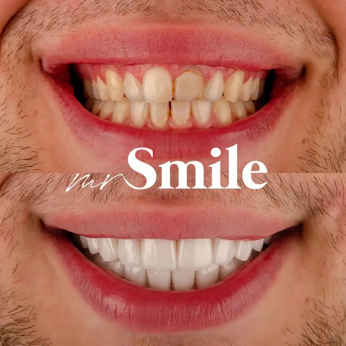 Mr Smile Preview – dizajn budućeg osmeha — detalj tretmana i rezultata