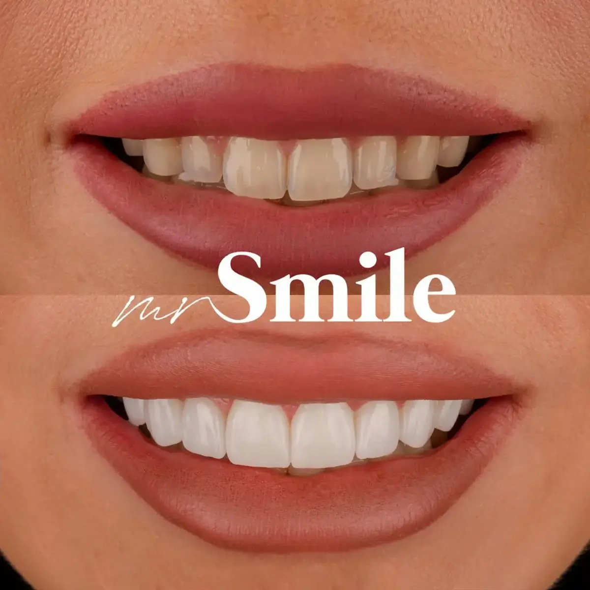Mr Smile Ortho – ortodontska korekcija zuba — detalj tretmana i rezultata