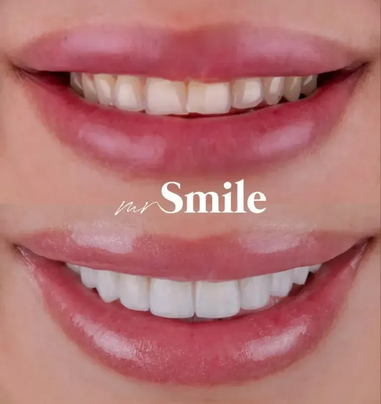 Mr Smile Preview – dizajn budućeg osmeha — Mr Smile