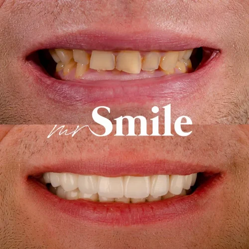 no_pre_vinyl_nemanja_mihaljcic_najbolja_stomatoloska_ordinacija_beograd_srbija_mrsmile_bel_osmeh_najlepsi_osmeh_1