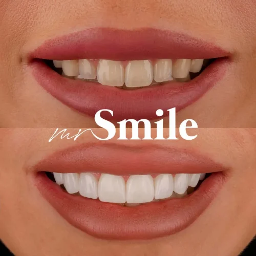 no_pre_vinyl_nemanja_mihaljcic_najbolja_stomatoloska_ordinacija_beograd_srbija_mrsmile_bel_osmeh_najlepsi_osmeh_bez_boli