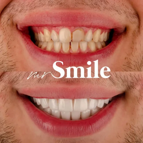 no_pre_vinyl_nemanja_mihaljcic_najbolja_stomatoloska_ordinacija_beograd_srbija_mrsmile_bel_osmeh_najlepsi_osmeh_jedinstveni