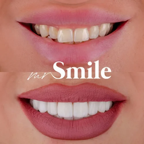 no_pre_vinyl_nemanja_mihaljcic_najbolja_stomatoloska_ordinacija_beograd_srbija_mrsmile_bel_osmeh_najlepsi_osmeh_jednostavnost