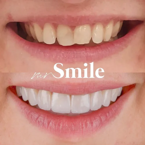 no_pre_vinyl_nemanja_mihaljcic_najbolja_stomatoloska_ordinacija_beograd_srbija_mrsmile_bel_osmeh_najlepsi_osmeh_konzilij